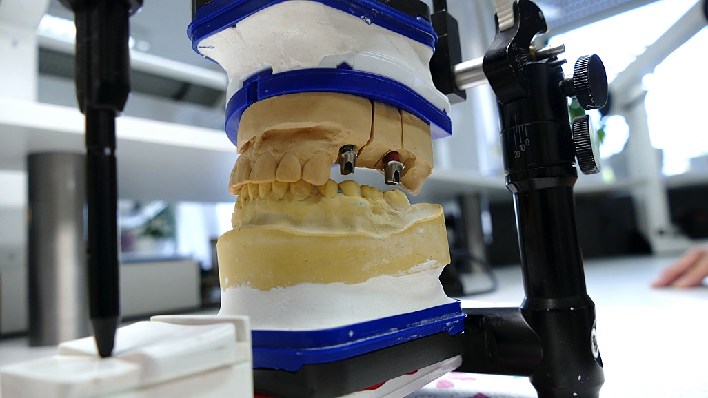 Fertige Brückenversorgung aus Zirkon – hochwertige Zahntechnik aus Stutensee